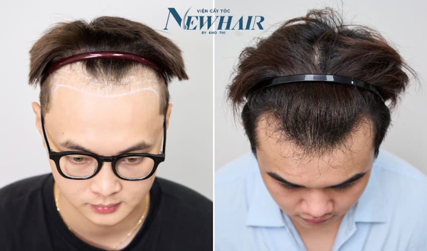 hói chữ M là gì