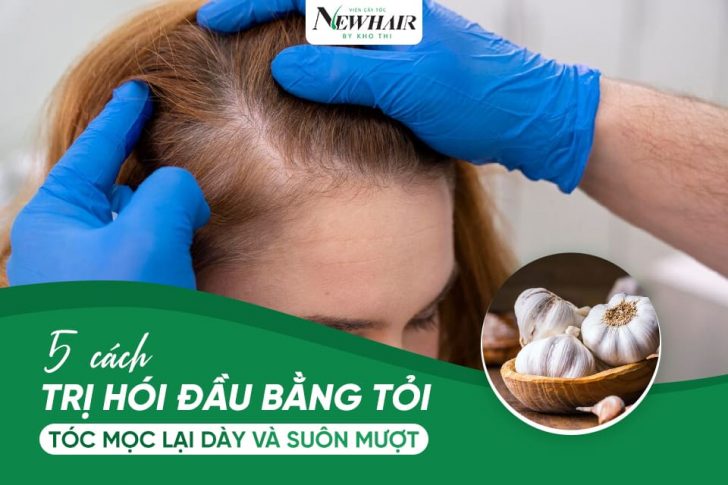 cách trị hói đầu bằng tỏi