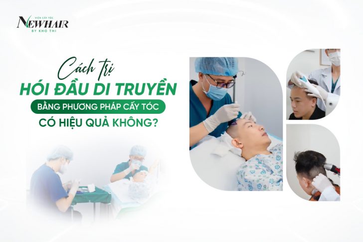 cách trị hói đầu di truyền