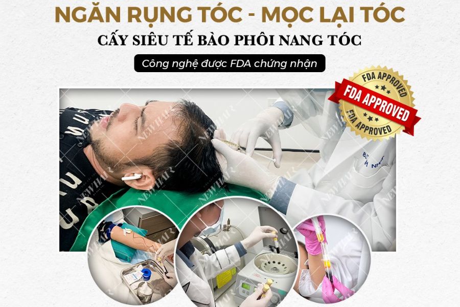 cấy siêu tế bào phôi nang tóc NewHair