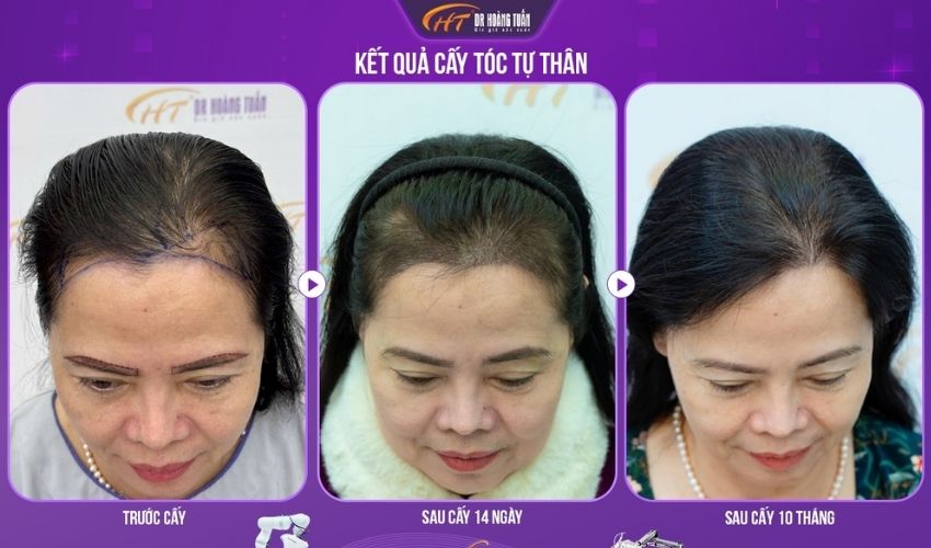 cấy tóc dr hoàng tuấn