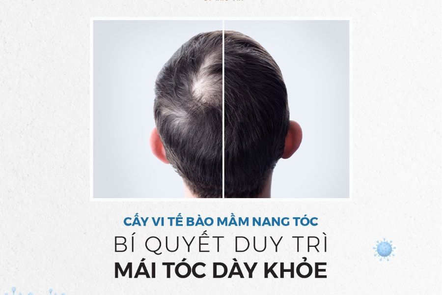 Cấy vi tế bào mầm nang tóc NewHair