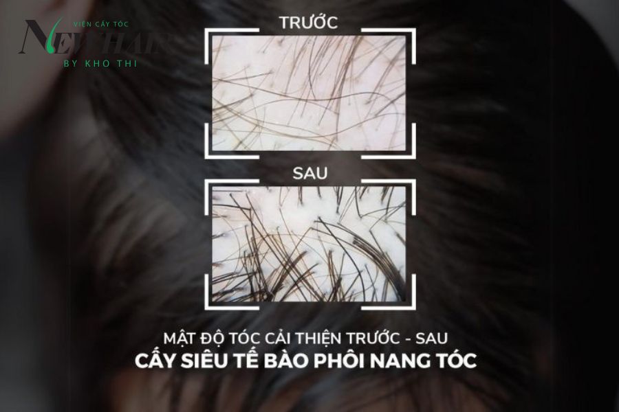 Cấy siêu tế bào phôi nang tóc phương pháp trị hói hiện đại