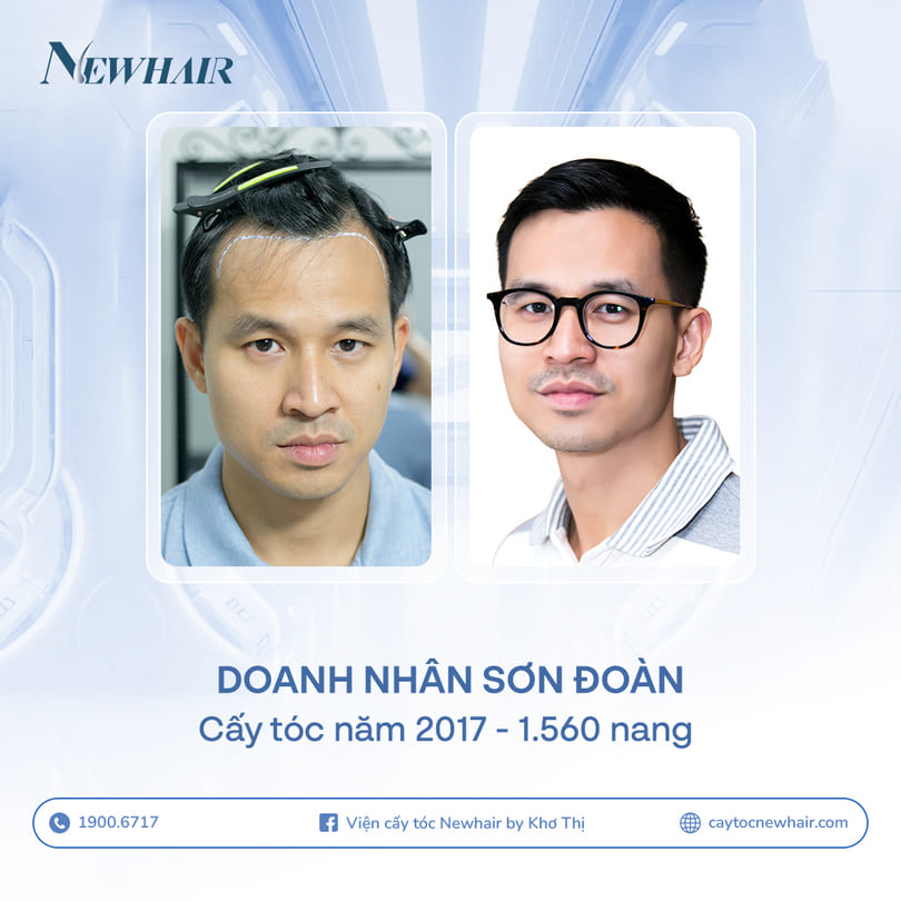 sơn đoàn cấy tóc newhair
