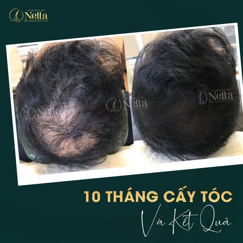 viện cấy tóc nella