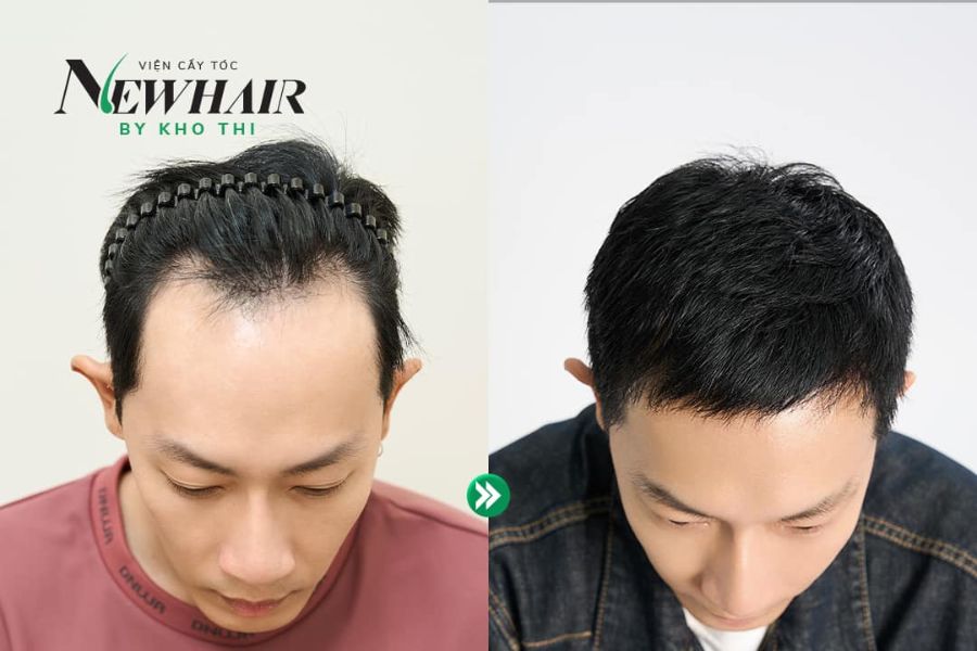 Cấy tóc CNC trị hói triệt để tại NewHair 