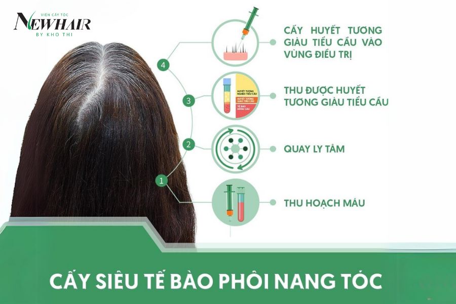 Cách trị hói đầu hiệu quả bằng cấy Siêu tế bào phôi nang tóc