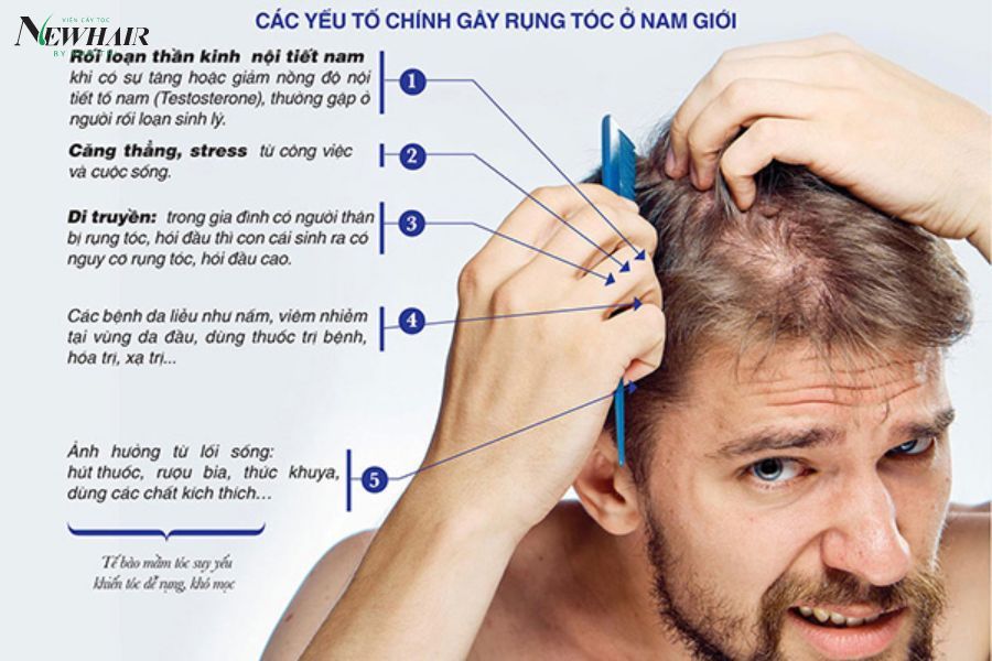 cách trị hói đầu ở nam giới