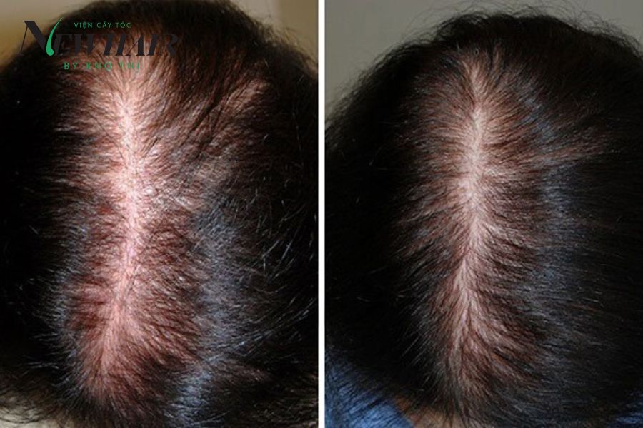 Thuốc Finasteride mang lại những công dụng gì giúp ích cho bạn