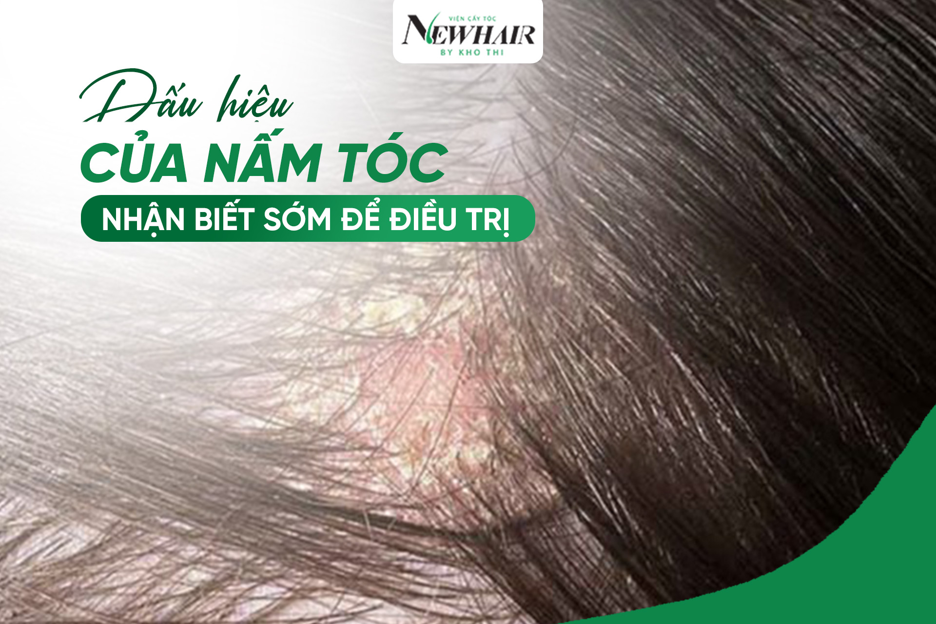 dấu hiệu của nấm tóc