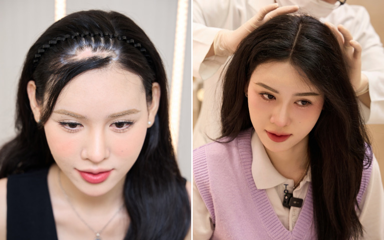 before after cấy tóc