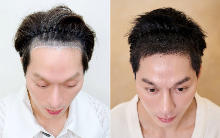 kỳ kỳ cấy tóc