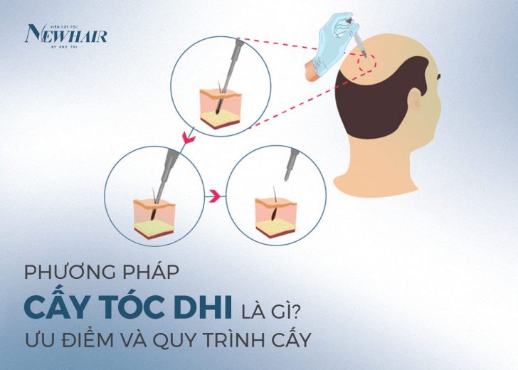 cấy tóc DHI là gì
