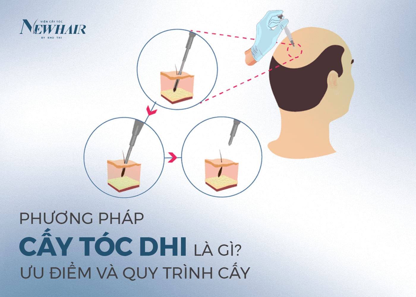 cấy tóc DHI là gì