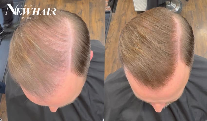 dấu hiệu của bệnh hói đầu