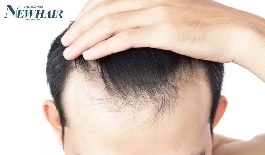 dấu hiệu của hói đầu