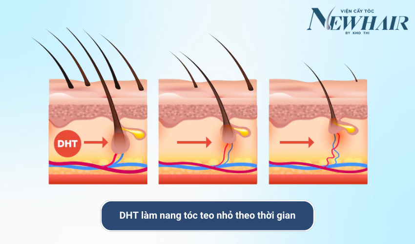 dht có gây hói không