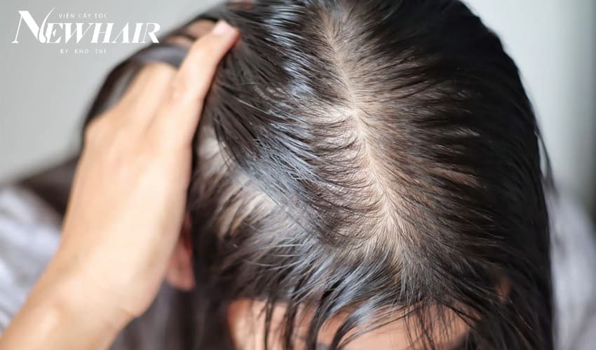 tiêm meso trị rụng tóc