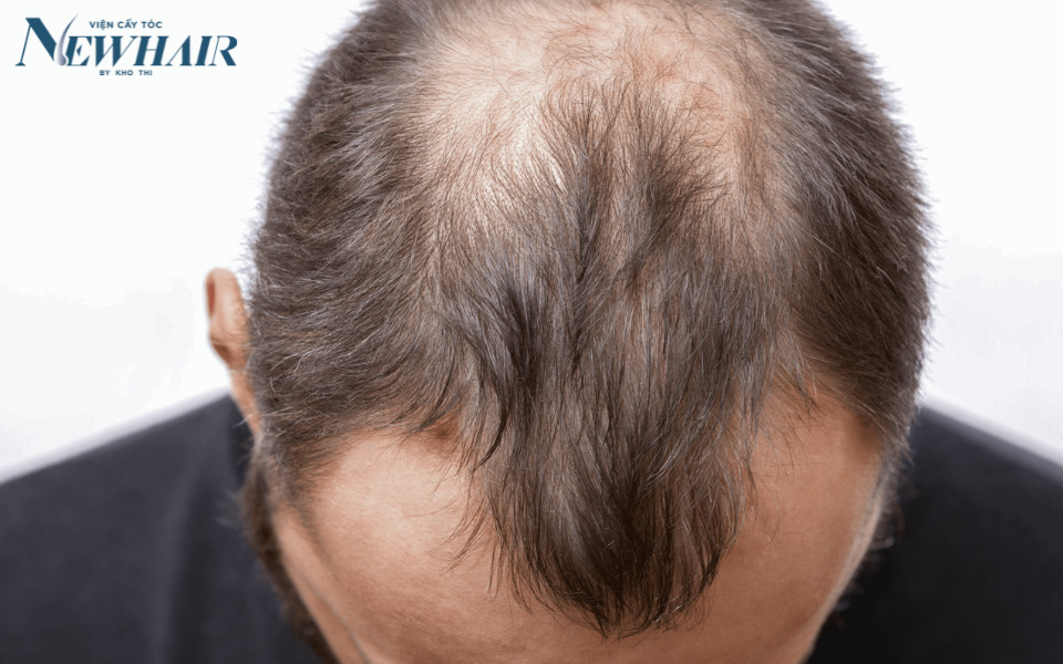 trị rụng tóc hói đầu