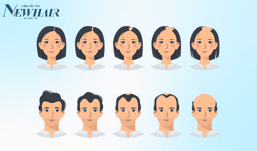 vì sao hormone dht gây hói đầu