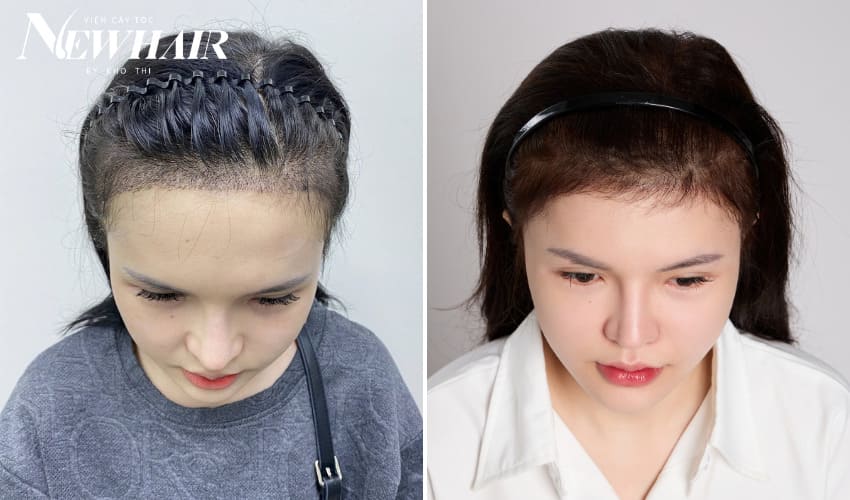 BA cấy tóc DHI