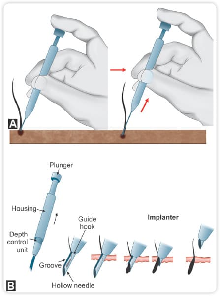 bút cấy DHI implanter