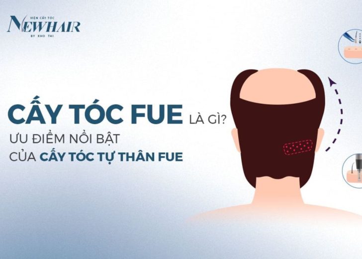 cấy tóc FUE là gì