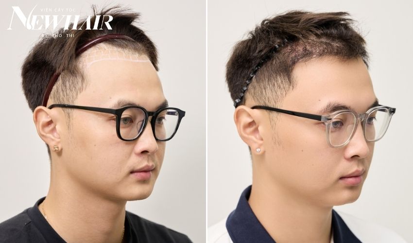 cấy tóc fue khơ thị