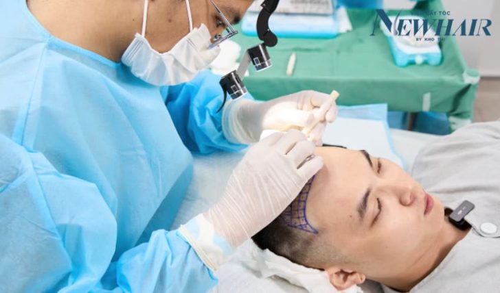 cấy tóc tự thân là gì