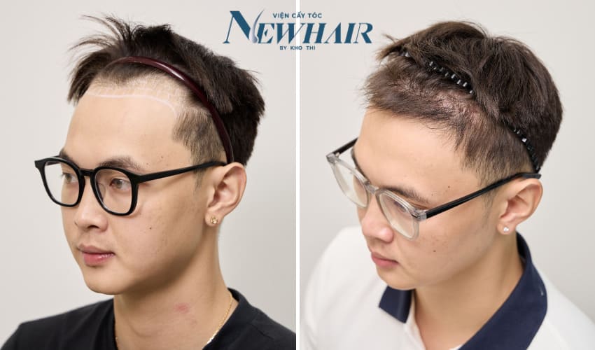 cấy tóc tự thân newhair by khơ thị