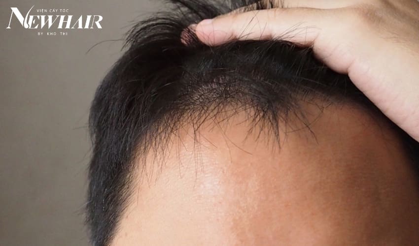 dấu hiệu còn nang tóc