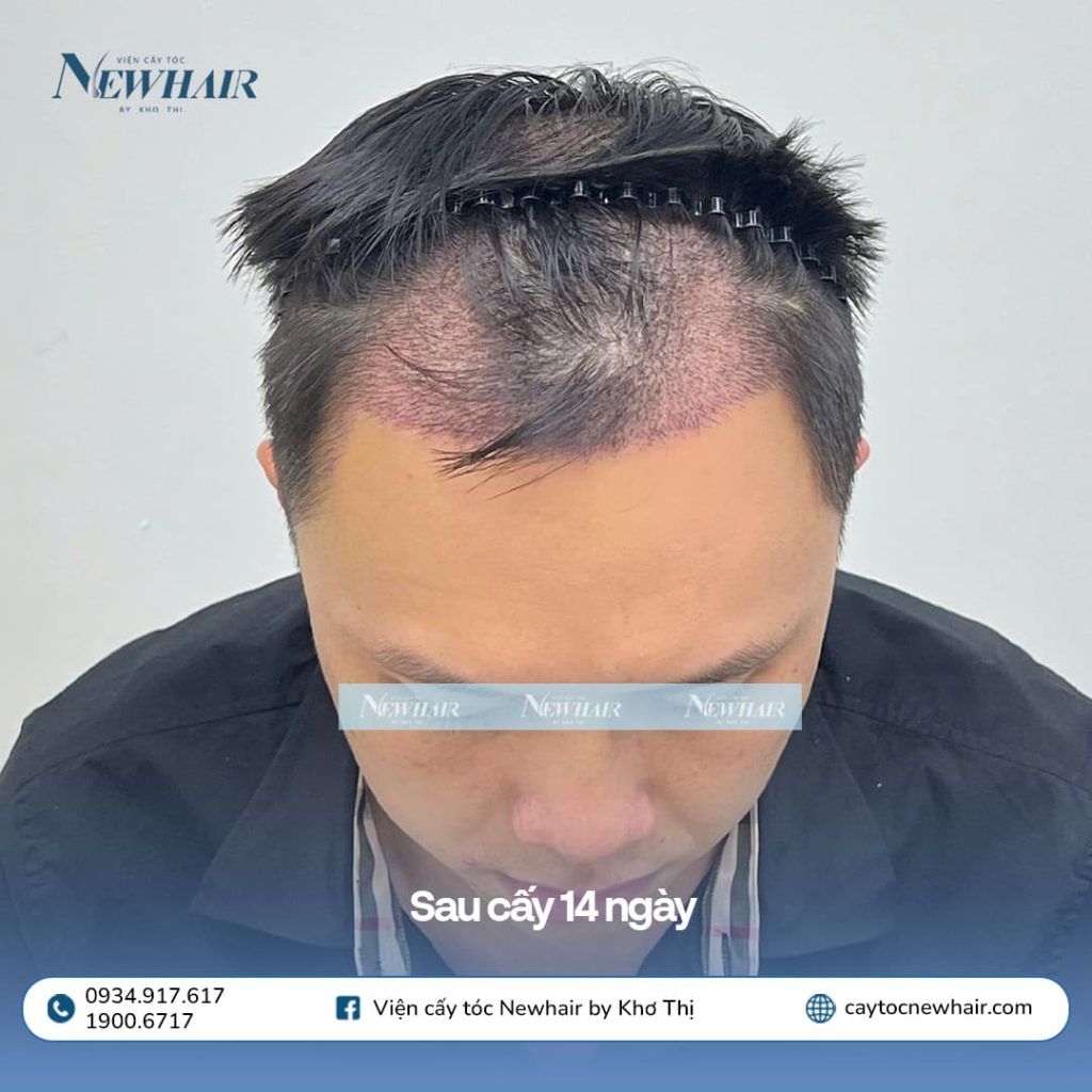feedback sau cấy 14 ngày
