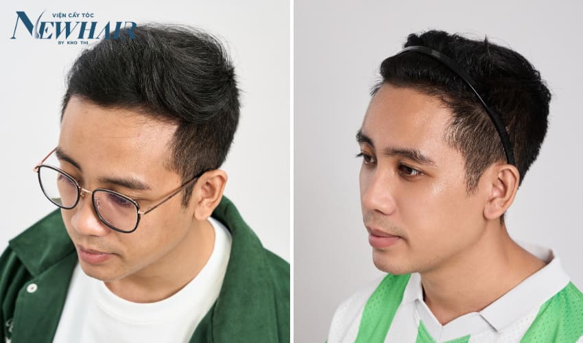 hiệu quả cấy tóc tự thân