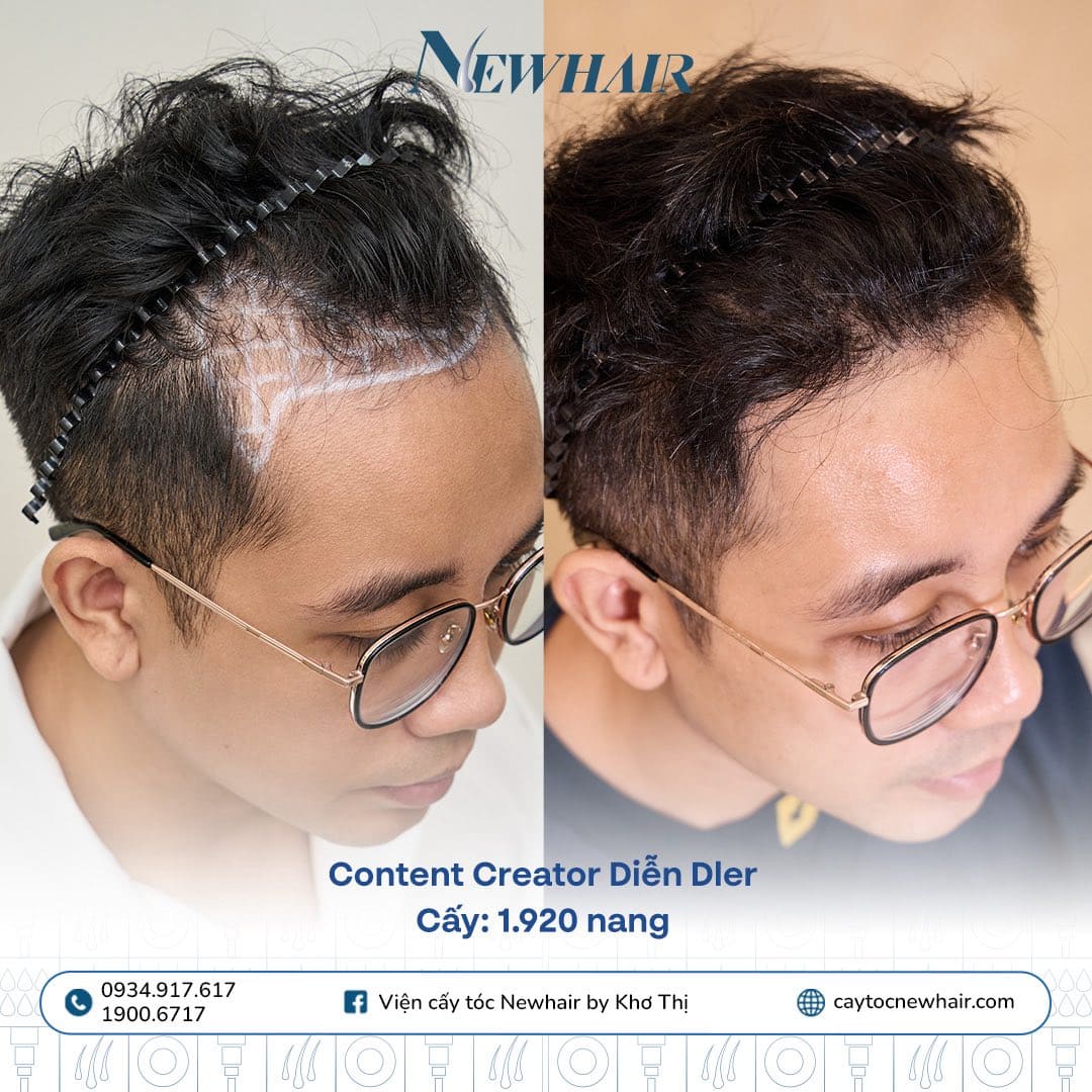 khách review cấy tóc dhi