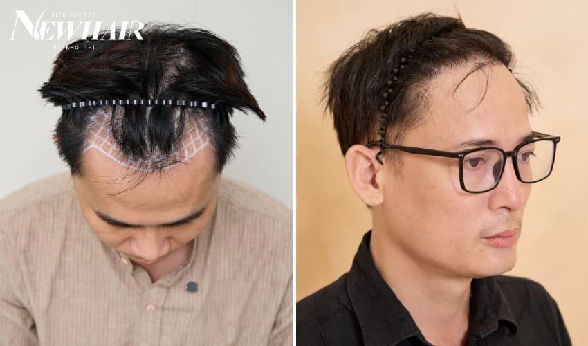 khi nào nên cấy tóc tự thân