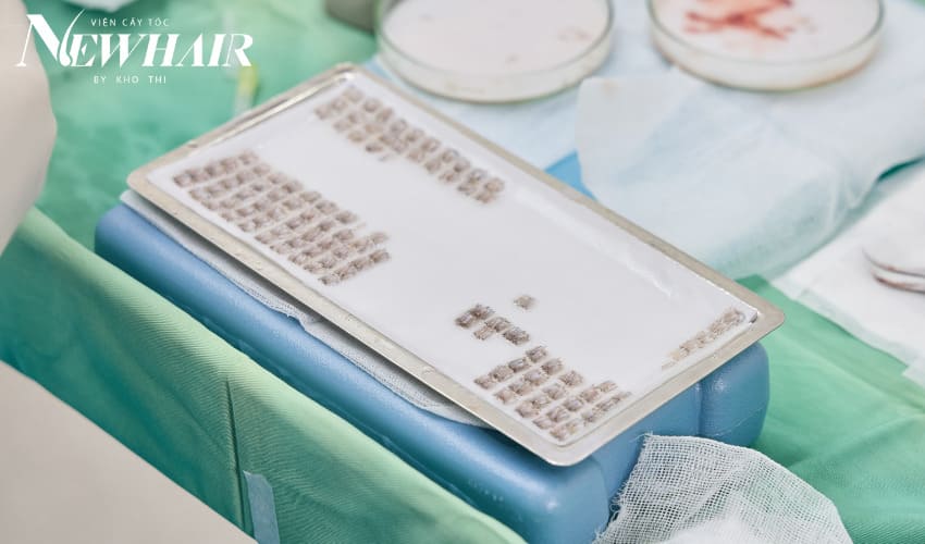 quy trình cấy tóc fue