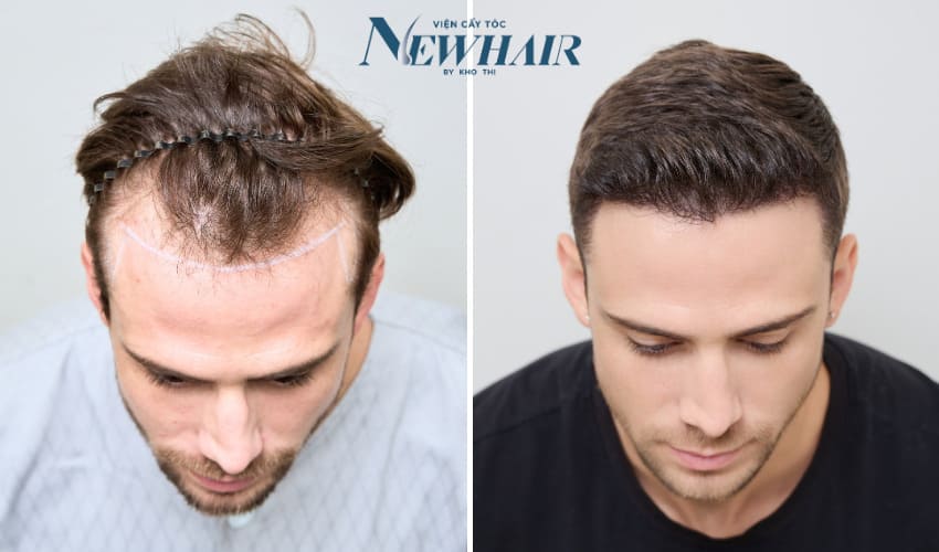 trị hói tại newhair khơ thị