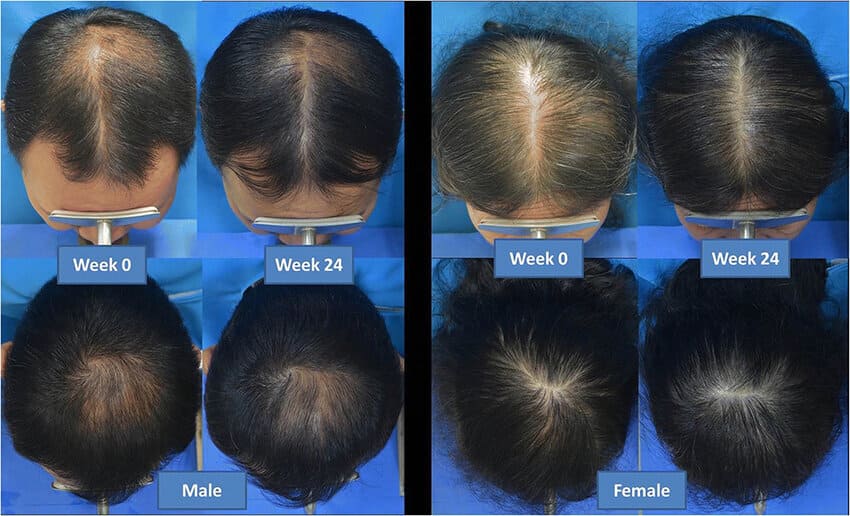 LLLT hair loss treatment