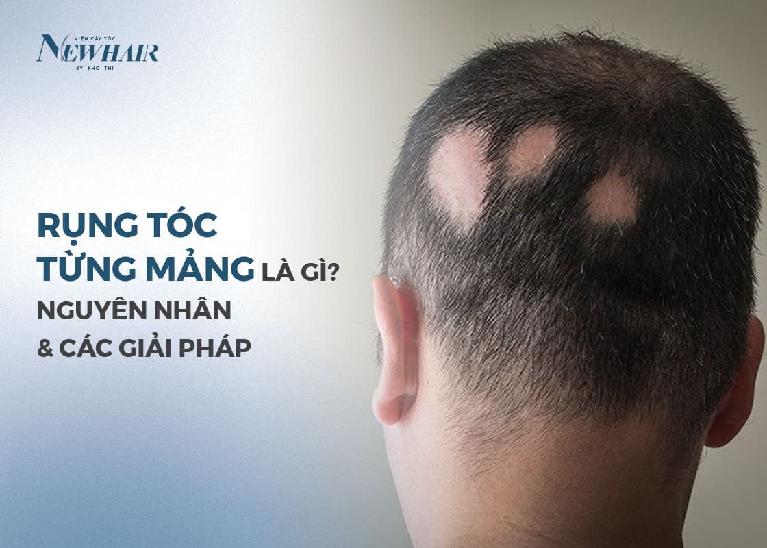 rụng tóc từng mảng