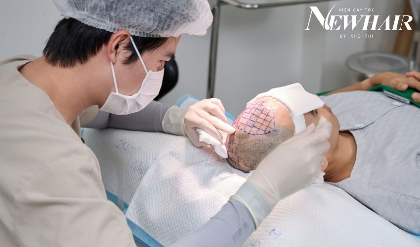 cấy tóc newhair