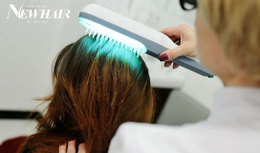 chữa hói đầu di truyền