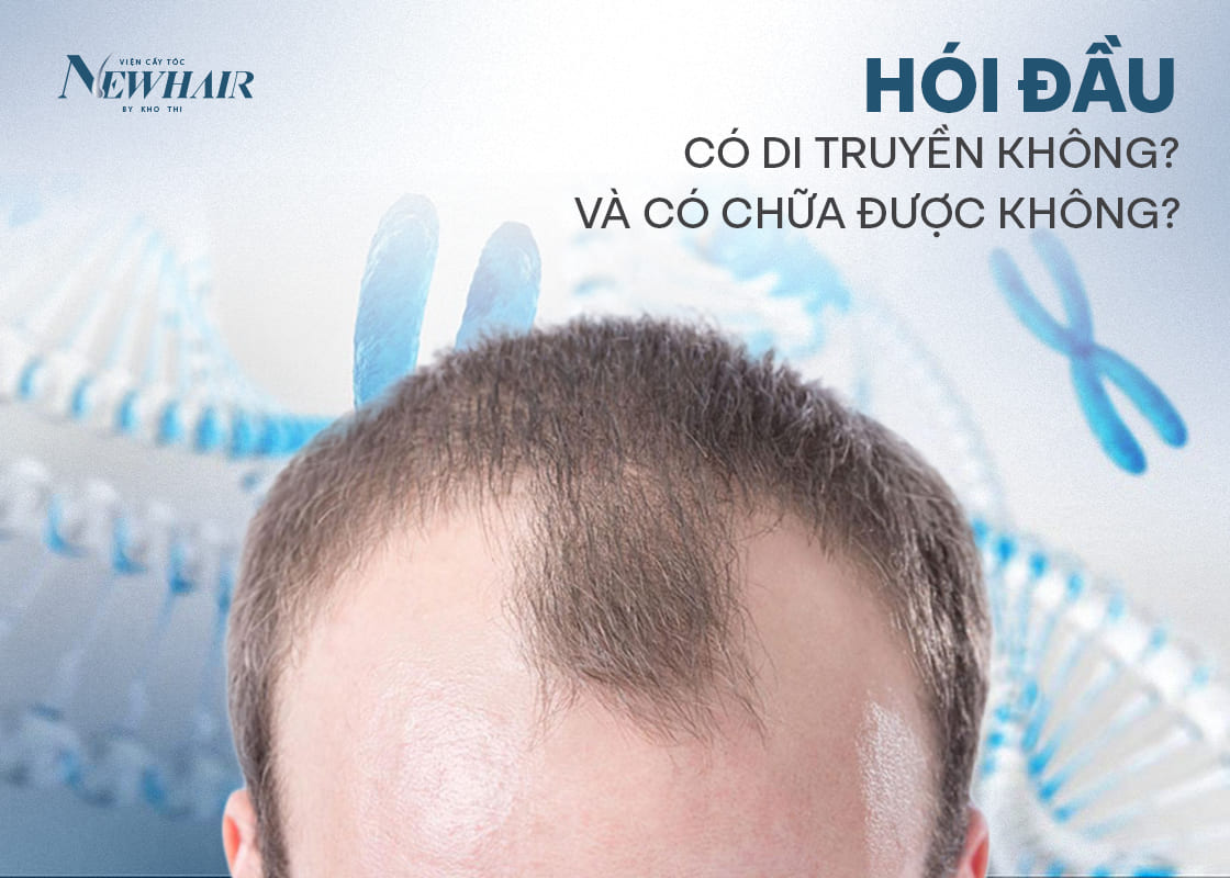 hói có di truyền không newhair