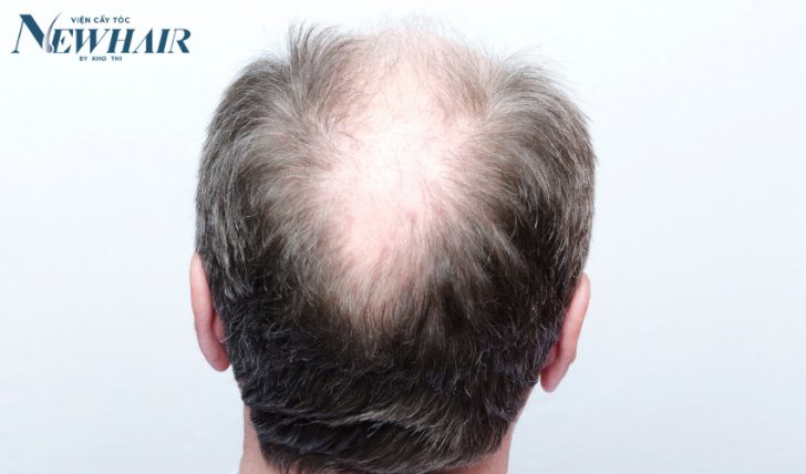 hói đầu có di truyền không