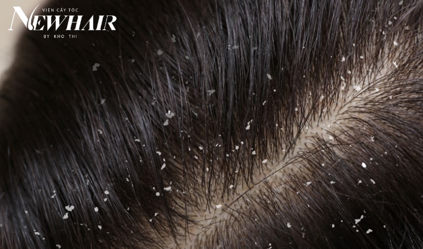 hói ở đỉnh đầu nữ