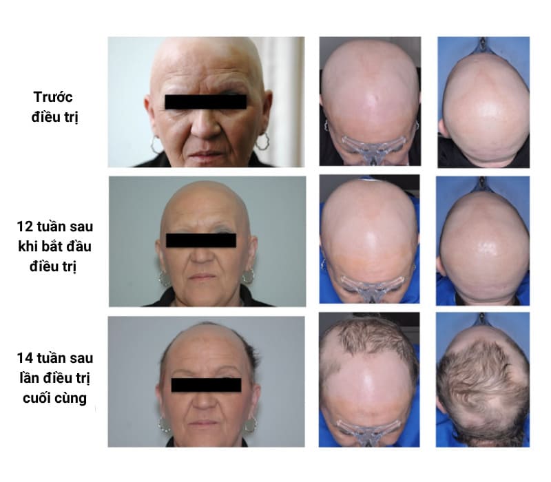 mẫu điều trị rụng tóc từng mảng
