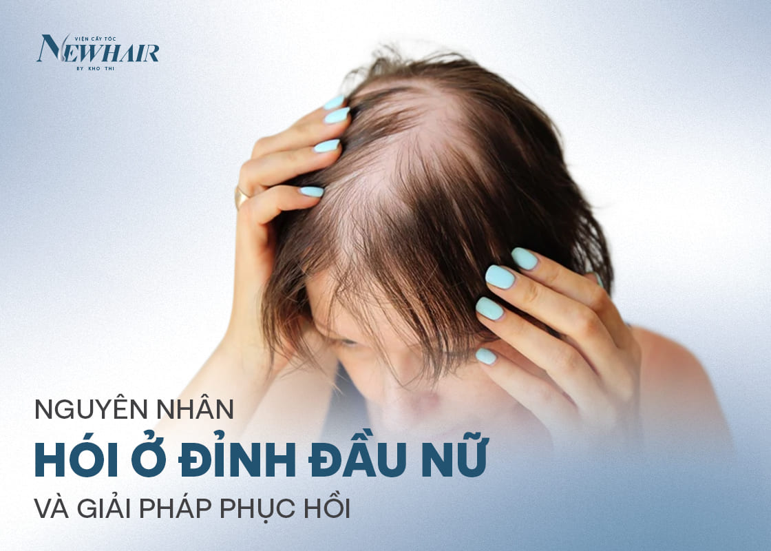 nguyên nhân hói ở đỉnh đầu nữ