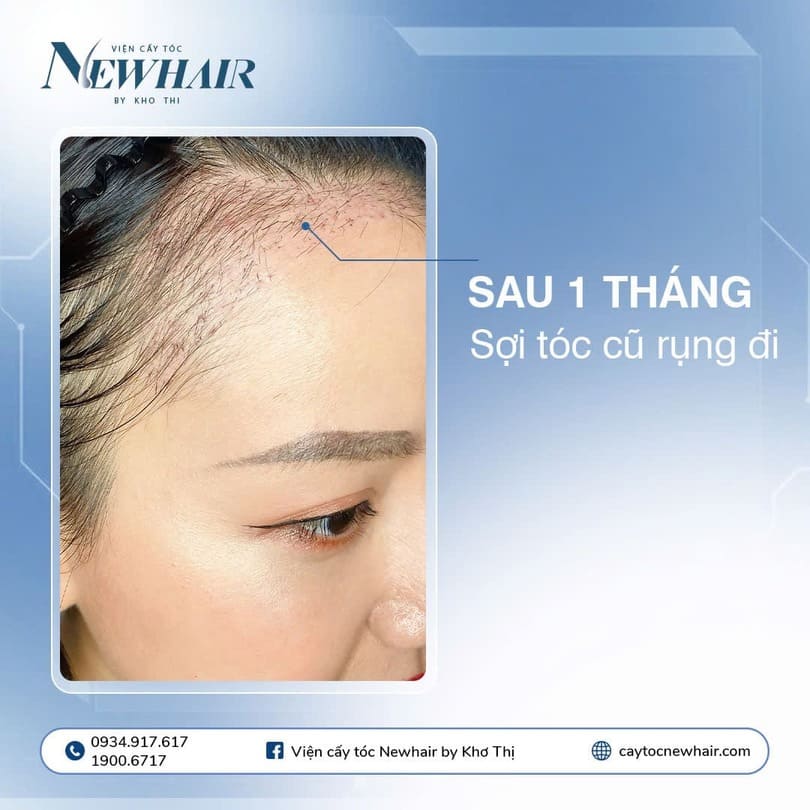 sau cấy tóc 1 tháng
