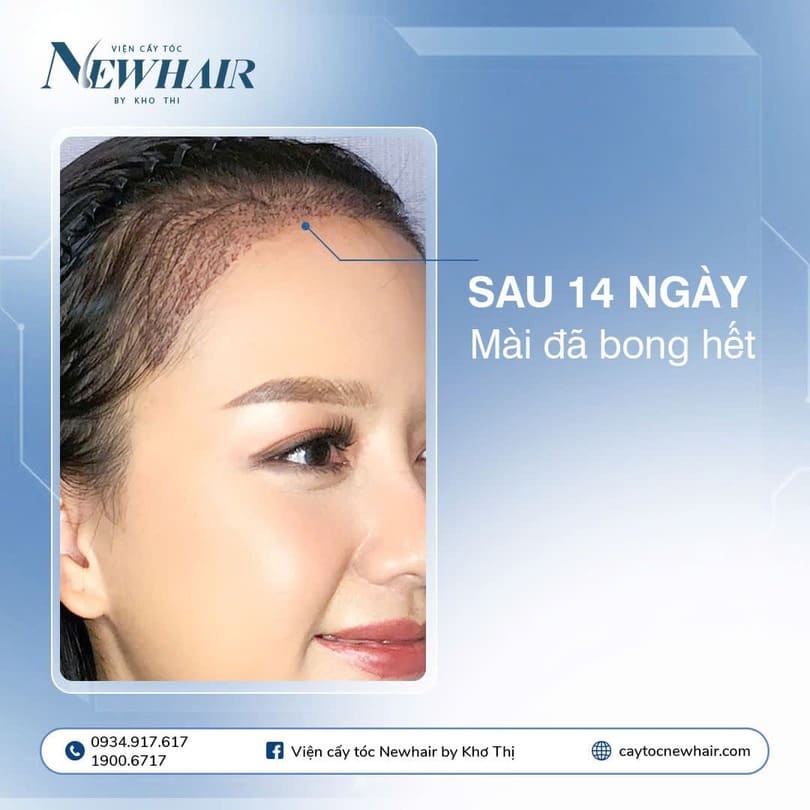 sau cấy tóc 14 ngày
