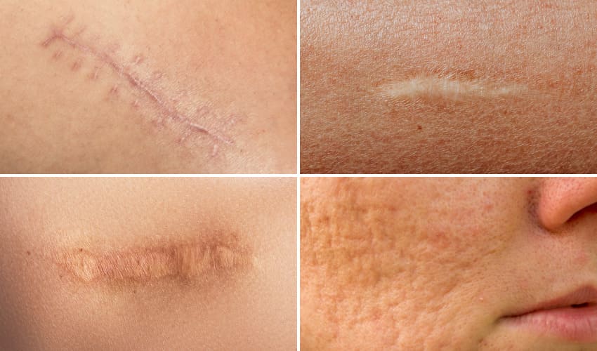 cấy tóc che sẹo