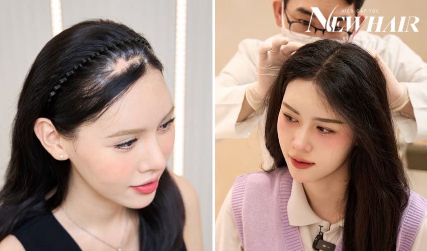 cấy tóc trên sẹo newhair